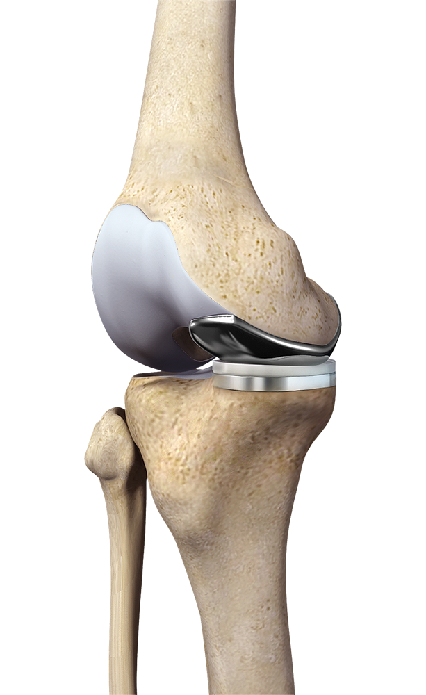 Half Knee Replacement