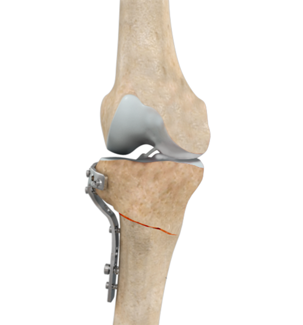High Tibial Osteotomy