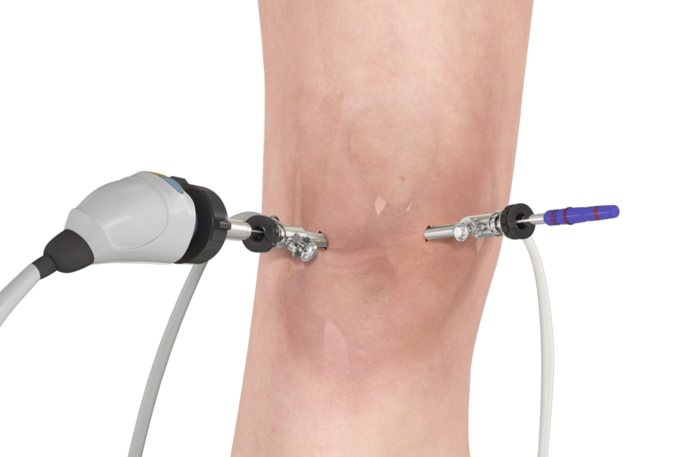 Keyhole Surgery