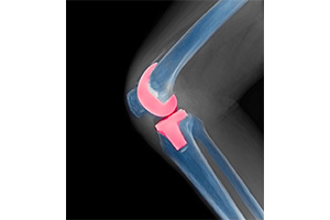 Knee Arthroplasty