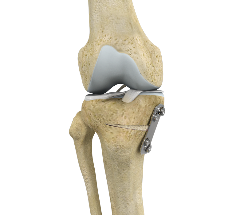 Knee Osteotomy