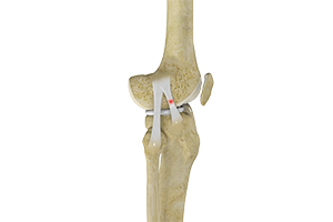 Knee Sprain