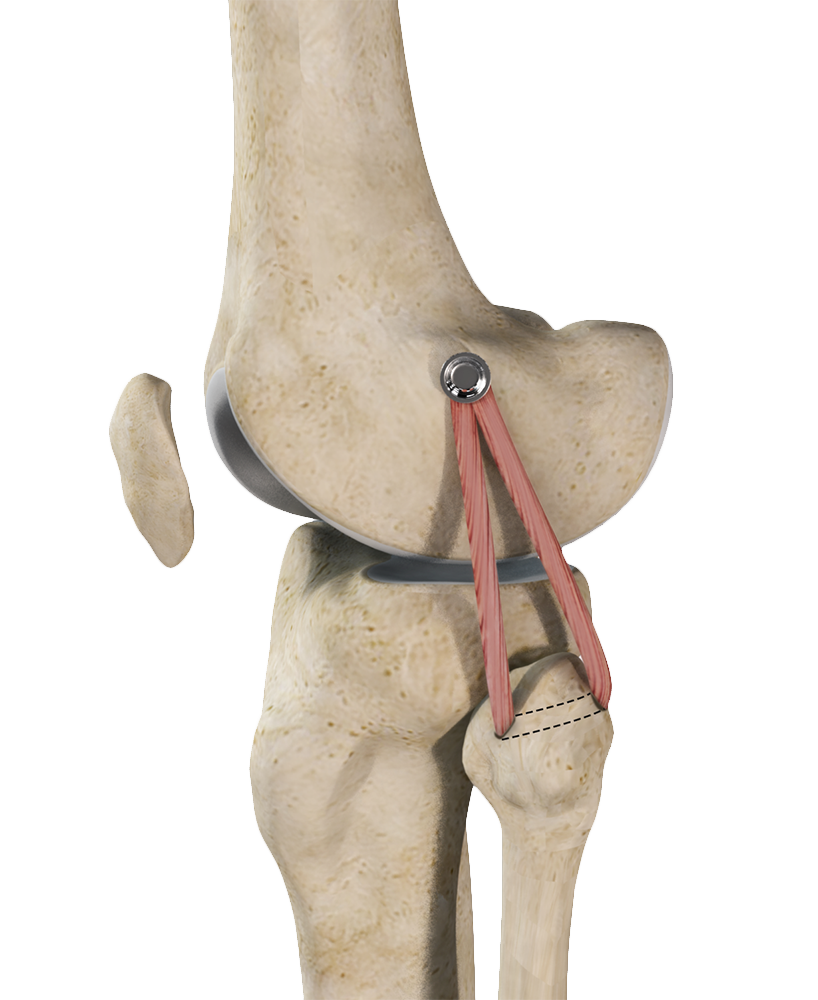 LCL Reconstruction