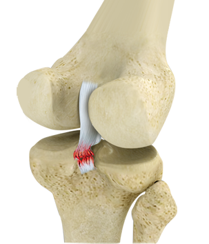 Ligament Injuries
