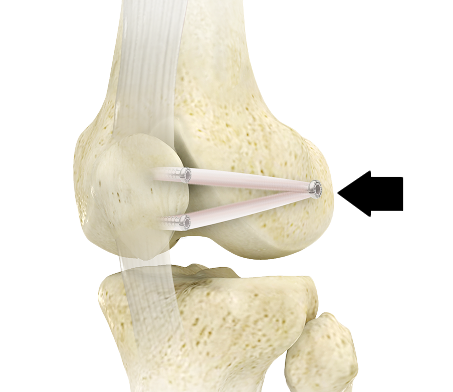 Medial Patellofemoral Ligament Reconstruction