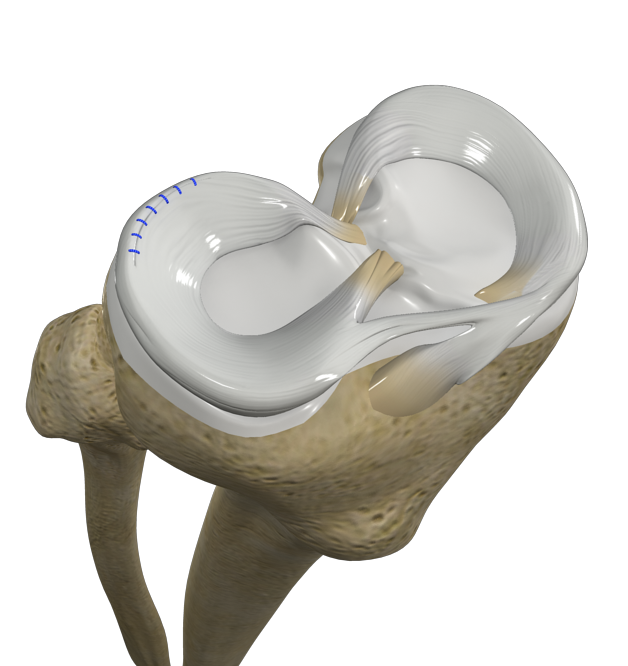 Meniscal Repair
