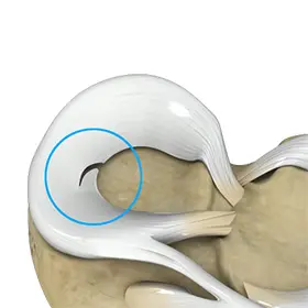 Meniscal Tears