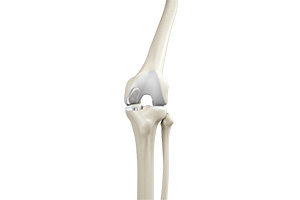 Partial Knee Replacement