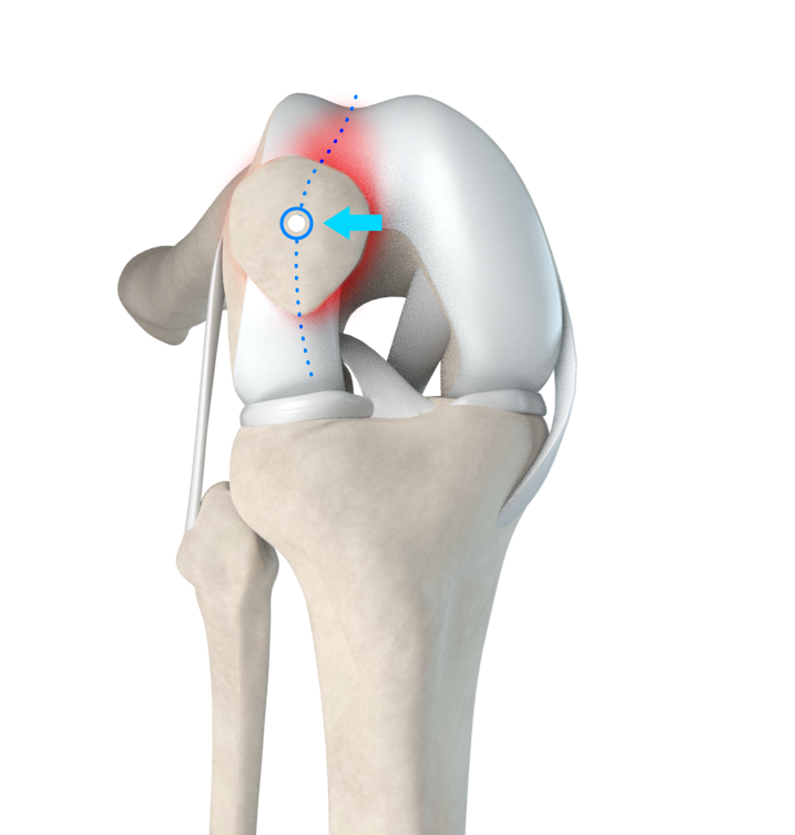 Patellar Maltracking and Instability