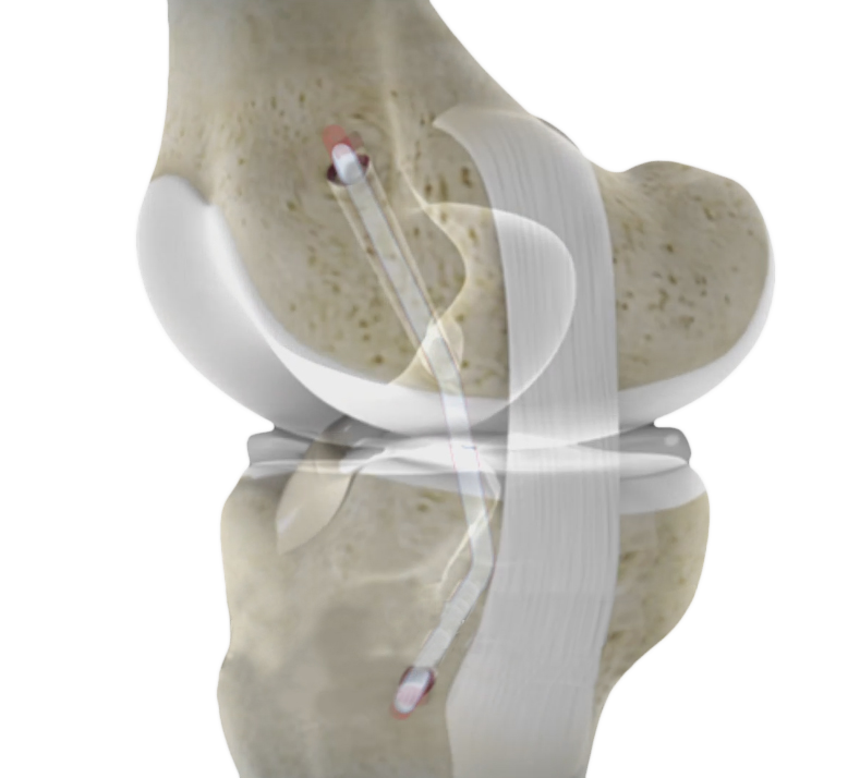 PCL Reconstruction