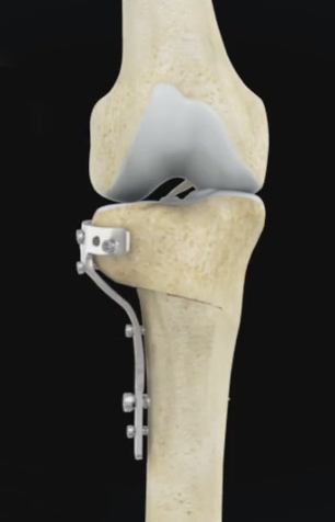 Realignment Surgery