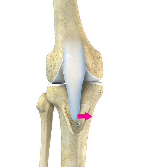 Tibial Tubercle Osteotomy