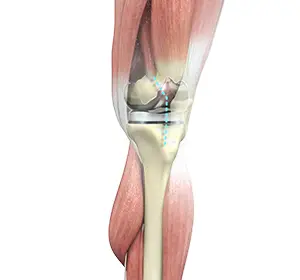 Total Knee Replacement