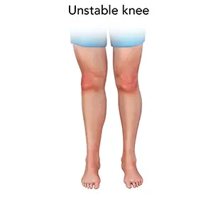 Unstable Knee