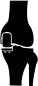 Partial (Unicompartmental)<br>Knee Replacement