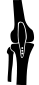 Tibial Tubercle Transposition