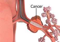 Airway Stents and Valves Images
