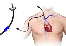 Right Heart Catheterization Images