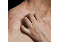 Urticaria & Angioedema Images