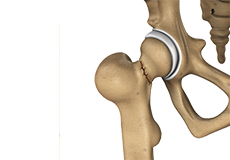 Hip Fracture - Educational Picture