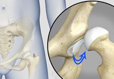 Hip Instability - Educational Picture