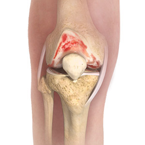 Knee Osteoarthritis - Educational Picture