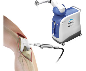 Mako Robotic-Arm Assisted Technology for Total Knee Replacement - Educational Picture