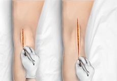 Minimally Invasive Approaches to Knee - Educational Picture