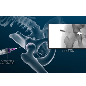 Non-surgical Treatment of Hip - Educational Picture