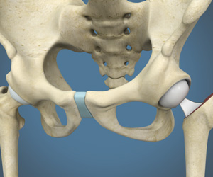Partial Hip Replacement - Educational Picture