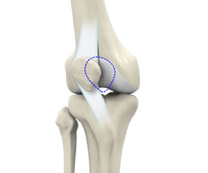 Patello-femoral Knee Replacement - Educational Picture