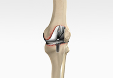 Revision Knee Surgery - Educational Picture