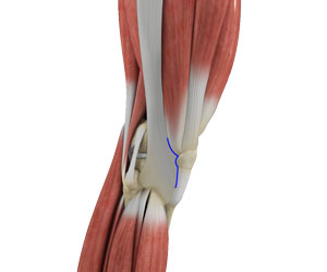 Subvastus Muscle Sparing Total Knee Replacement - Educational Picture