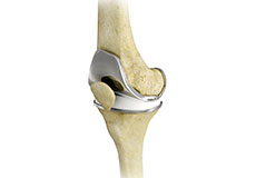 Total Knee Replacement - Educational Picture