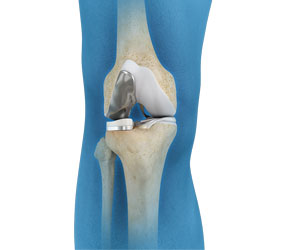 Uni condylar Knee Replacement - Educational Picture
