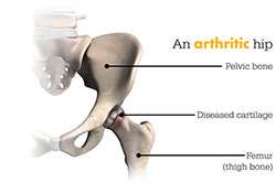 arthritic hip