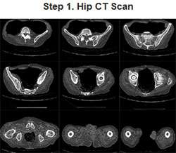 Robotic Hip Replacement Surgery Oklahoma City | Edmond