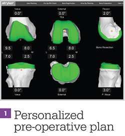 personalized preoperative plan