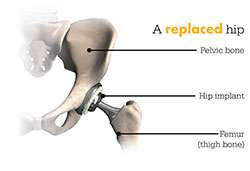 replaced hip