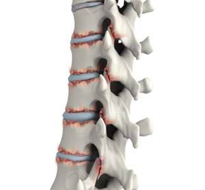 Ankylosing Spondylitis(inflammation of the spine) 
