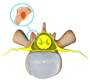 Spinal Tumors(Spinal)