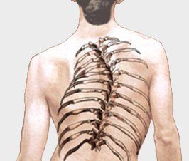 Scoliosis Correction