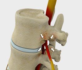 Spinal Stenosis Treatment