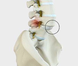 Spondylolisthesis Treatment 