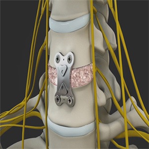 Anterior Cervical Discectomy with Fusion (ACDF)