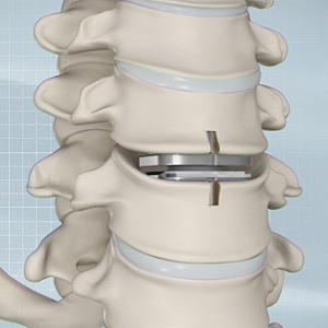 Artificial Cervical Disc Replacement