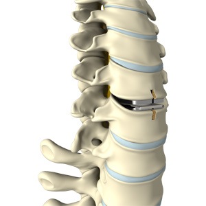 Artificial Disc Replacement
