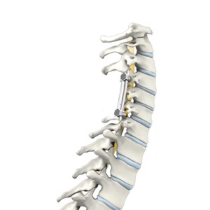 Cervical Fusion
