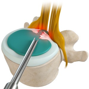 Discectomy