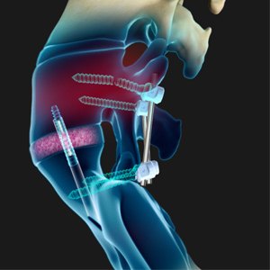 Failed Back Surgery